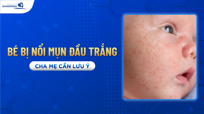 Bé bị nổi mụn đầu trắng