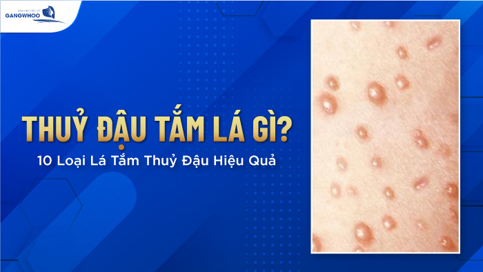 Bị thủy đậu tắm nước lá gì?