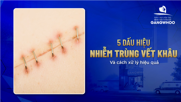 5 Dấu Hiệu Nhiễm Trùng Vết Khâu Và Cách Xử Lý Hiệu Quả