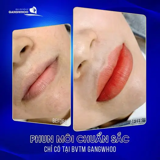 Tìm hiểu về phun môi collagen